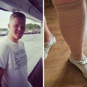 Edward Taylor and his bandaged left leg