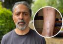 South London dad Danny Afzal said the communal areas of his block of flats in Lewisham Park had been left flea-infested for almost a year, despite persistent complaints