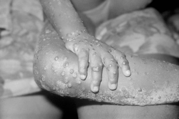 News Shopper: The monkeypox virus can be spread in a number of ways. Picture: PA