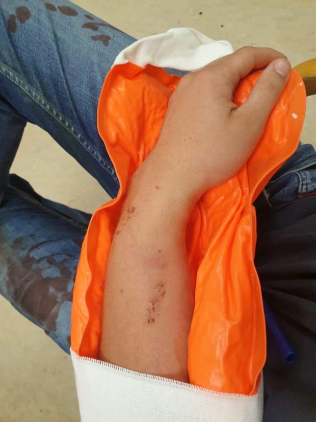 News Shopper: Brandon's arm after the incident 