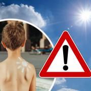 Expert: Parents who let their kids get severely sunburnt should be FINED
