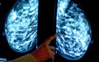 Thousands of women miss ‘vital’ breast cancer screenings in south east London