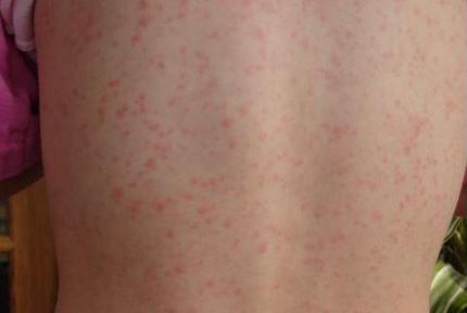 Sharp rise of Scarlet Fever in south east London - here's how to spot it